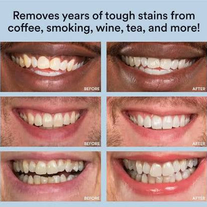 PureSmile™ — Get Whiter Teeth in Just 7 Days From Home